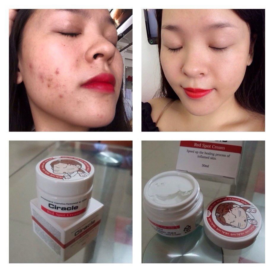 Kem trị mụn ciracle red spot cream